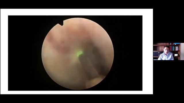 WEBINAR ENUCLEACIÓN PROSTÁTICA