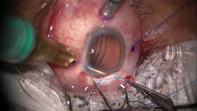 Aniridia IOL_Four Flange Technique смотреть онлайн