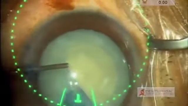 Verus Caliper In Challenging Situations