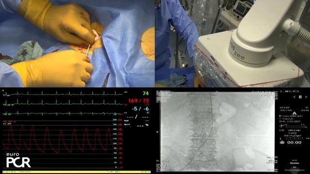 Planning for a lifetime starts with choosing the right valve first: from first TAVI to redo-TAVI смотреть онлайн