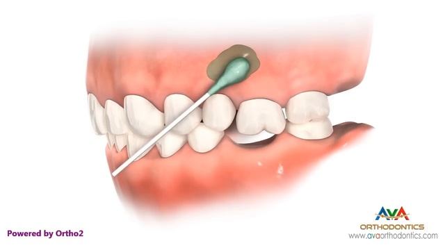 Temporary Anchorage Device or TAD - Orthodontic Appliance смотреть онлайн