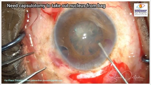 114 PXF Severe zonular laxity-Thought process-Conversion to SICS +iris claw Dr Sourabh Patwardhan смотреть онлайн