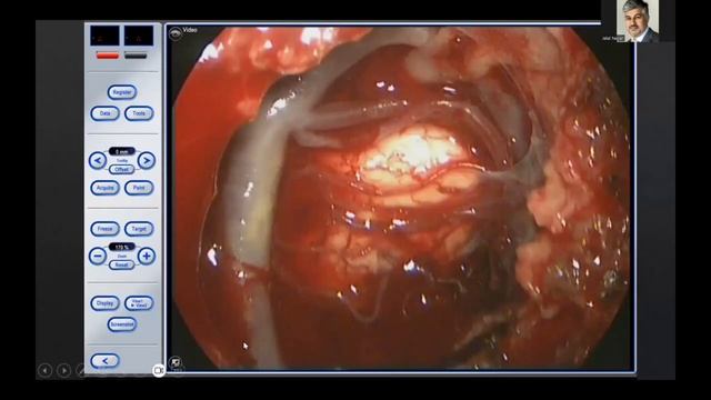 Posterior Fossa Lesions – Professor Ramesh Nair смотреть онлайн