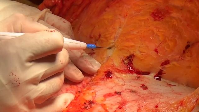 What Does Scar tissue look like on the inside? | North Texas Plastic Surgery | Dallas, Texas смотреть онлайн