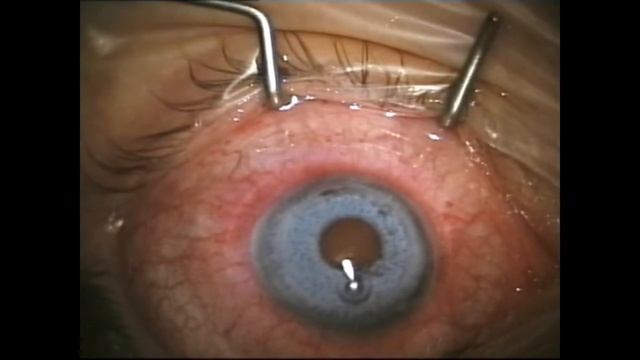 Disasters of Cosmetic iris prothesis -Bright Ocular смотреть онлайн