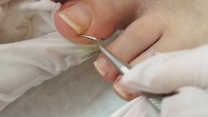 Подногтевые мозоли. Ковыряю и обрезаю #ногти #педикюр #проблема