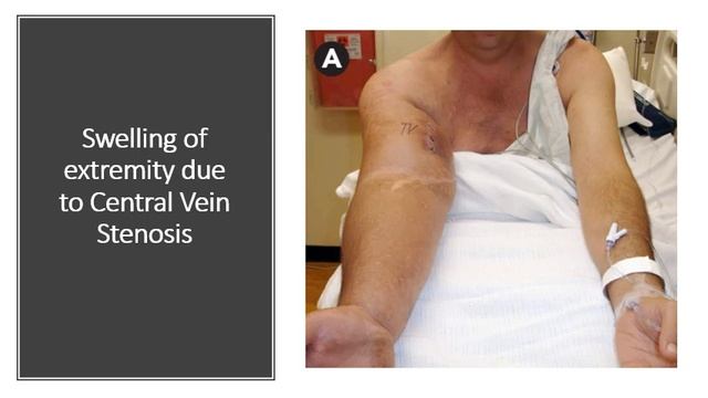 AV Fistula examination, Ahmed Elsaeed, MD смотреть онлайн