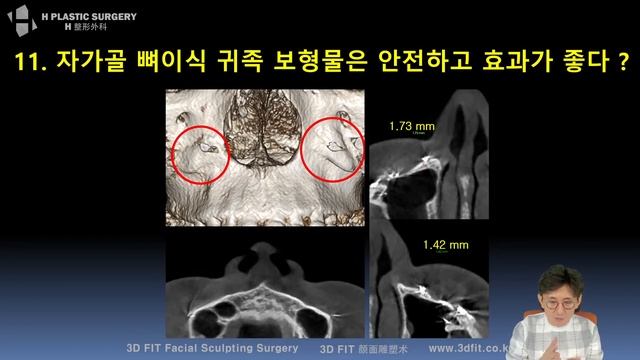 (ENG SUB) 자가골 뼈이식 귀족보형물은 안전하고 효과가 좋다? [팔자주름의 원인 및 해결방법 #11] смотреть онлайн