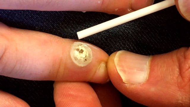 INFECTIOUS SEED WART!!! (Frozen With Liquid Nitrogen) | Dr Paul смотреть онлайн