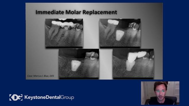 KDG VANGUARD | Dr. Blue - Molar Replacement Therapy Shifting the Clinical Paradigm смотреть онлайн
