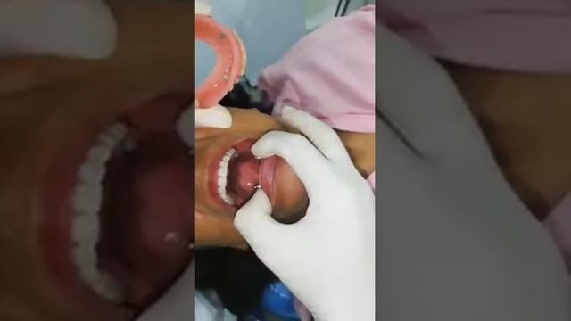 Tratamiento odontologico con prótesis implantó soportada. смотреть онлайн