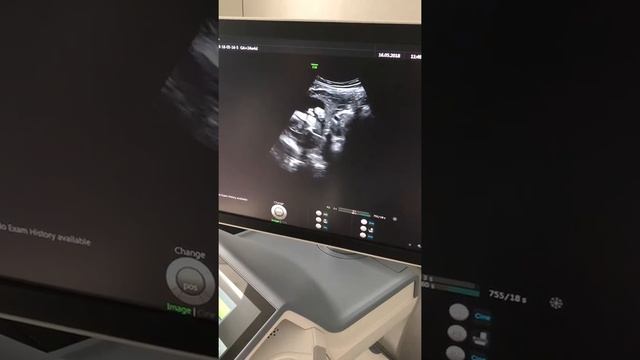 УЗИ с новым аппаратом VOLUSON E10 смотреть онлайн