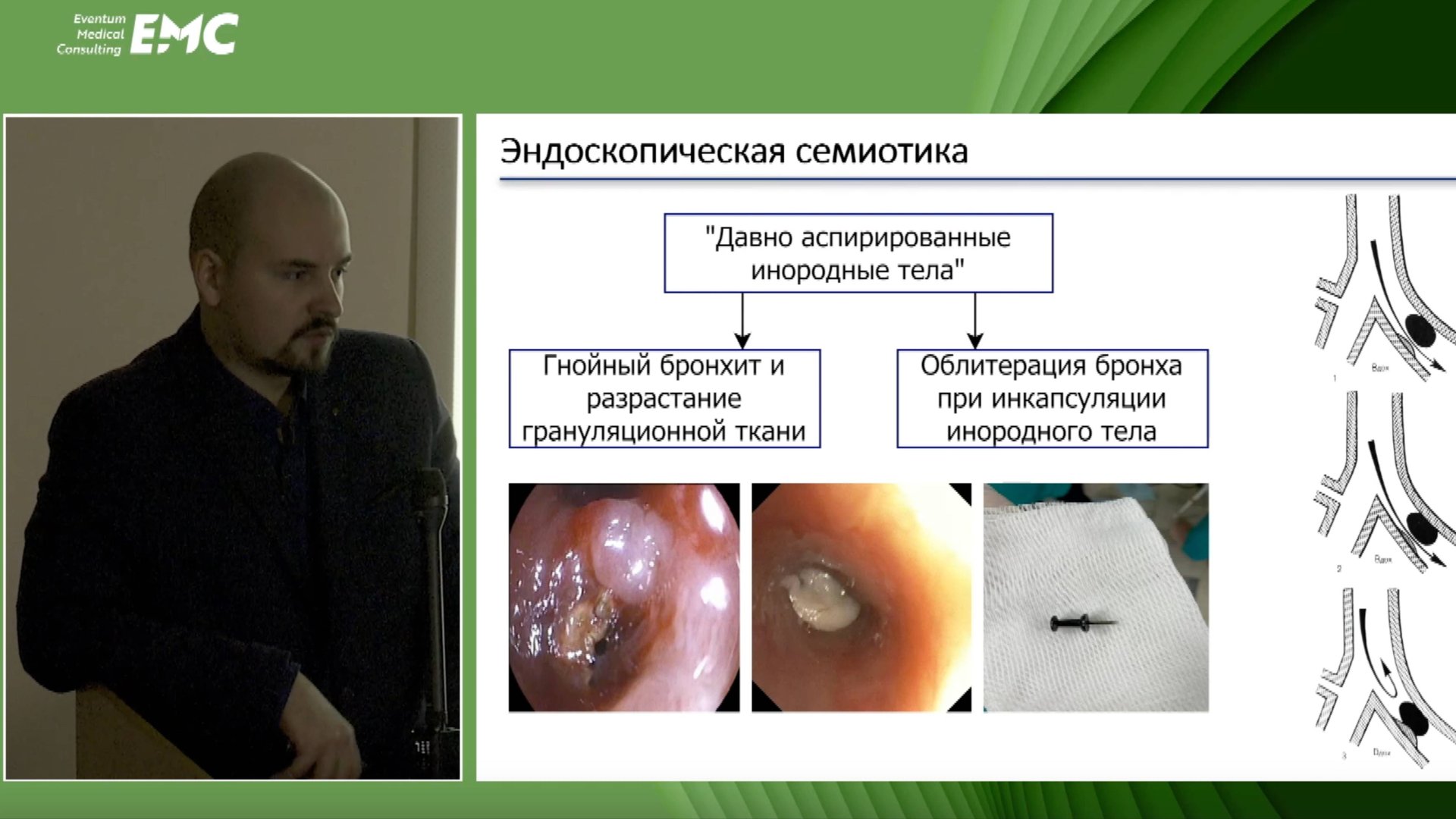 1. Новиков А.Ю., Вакурова Е.С. Им здесь не место или "давно аспирированные" инородные тела у детей