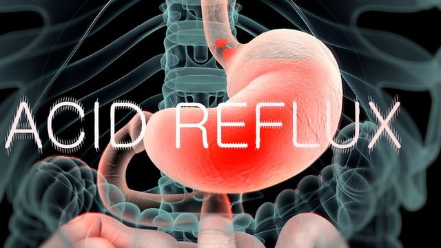 Signs and Symptoms of Acidity in Hindi | पेट में गैस / अम्ल के लक्षण क्या होते हैं? смотреть онлайн