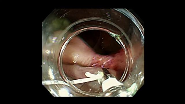 ESD by use of a modified dental floss clip method for recurrent tumor in the cecum смотреть онлайн