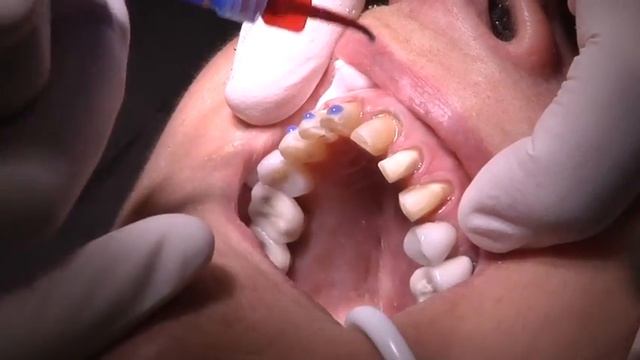 Veneer Replacement Procedure