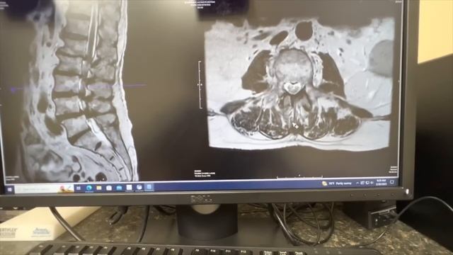 Minimally Invasive Surgery Options For Lumbar Spinal Stenosis In 2023. MIS4LSS.