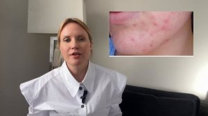 Причины прыщей (акне) на лице у взрослых и подростков, разбор врача #прыщи #уходзакожей #акне