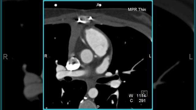 Cardiac: Occluded RIMA Graft in a patient with by-pass for aberrant coronary artery (2 of 4) смотреть онлайн