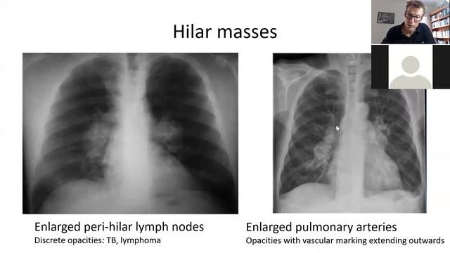 Weekly Paediatric Teaching 2021 32 Diagnosis of tuberculosis in children October 4 смотреть онлайн