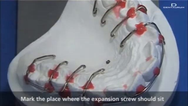 Orthocryl Позиционирование расширяющего винта при изготовлении ортодонтического аппарата