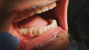 Циркониевые протезы на винтовой фиксации, на имплантатах мегаджен. 4я стоматология.