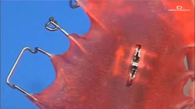 Orthocryl Финальная обработка и полировка ортодонтического аппарата