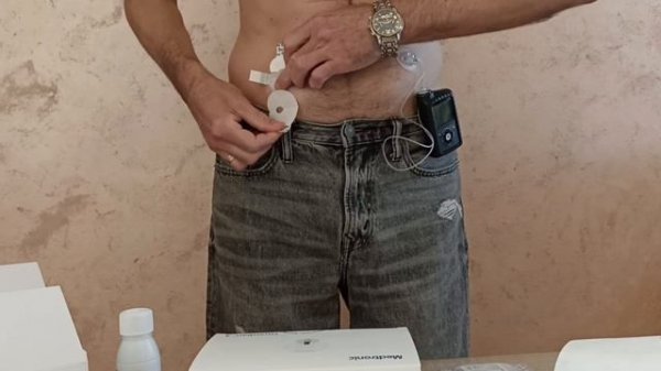 Замена трансмиттера MiniLink Medtronic 780g