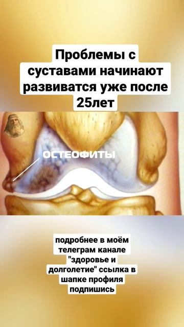 Проблемы с суставами начинают развиваться уже после 25 лет. #народнаямедицина #здоровьебезтаблеток смотреть онлайн