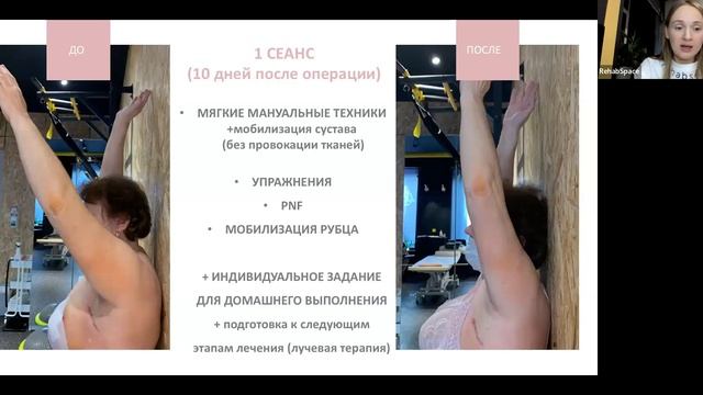 Физическая реабилитация при раке молочной железы с Альбиной Овчинниковой смотреть онлайн