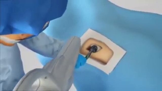 Stryker Mako Robotic Arm Assisted Total Hip Replacement