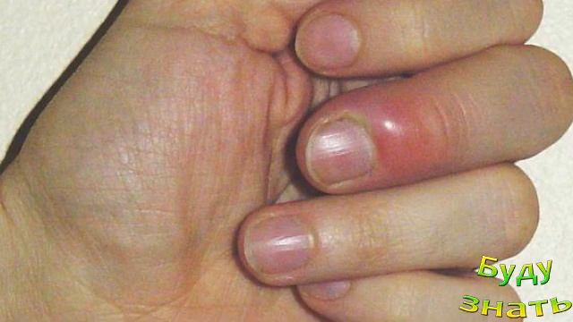 Нарывает палец! Вероятно, ПАНАРИЦИЙ? Как себе помочь? Почему такое возникает?