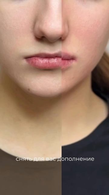 Зажившие в конце 😍 Стоит делать в таких случаях или нет? Пишите свое мнение в комментариях! 🙏🏻