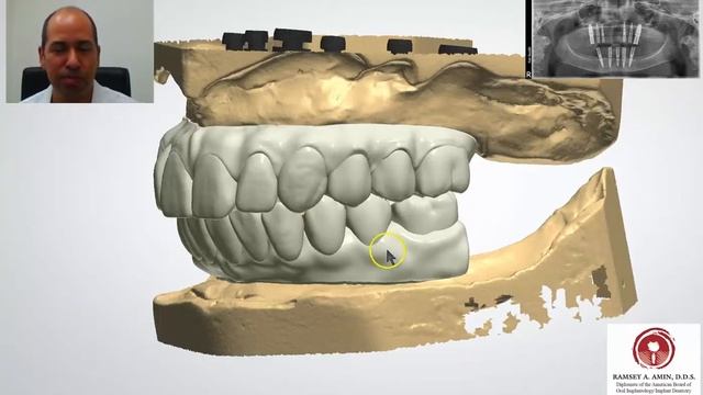 Full Arch All on 4, 5, 6, 7, 8 Implants - 3D Lab Teeth Design Video смотреть онлайн