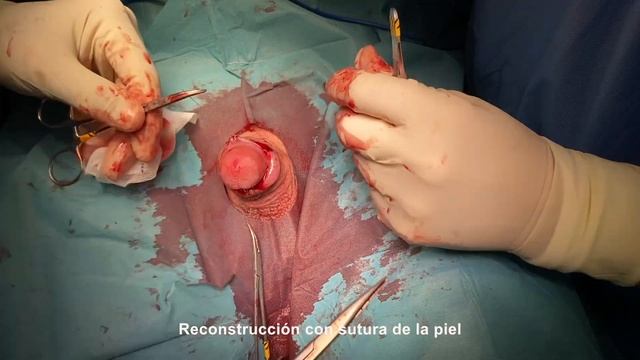 CIRCUNCISIÓN. Tratamiento De La Fimosis Y Craurosis Del Prepucio. Circumcision. Fimosis. Phimosis