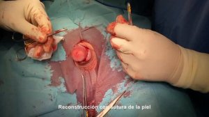 CIRCUNCISIÓN. Tratamiento de la fimosis y craurosis del prepucio. Circumcision. Fimosis. Phimosis