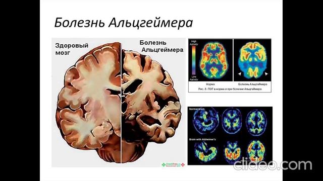 Болезнь Альцгеймера смотреть онлайн