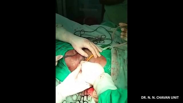 Transobturator Tape (TOT) Repair for Stress Urinary Incontinence (93) смотреть онлайн