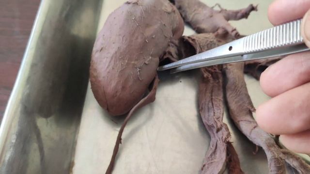 Kidney Anatomy | Kidney Demonstration Bangla | Anatomy of Kidney | Part 1 смотреть онлайн