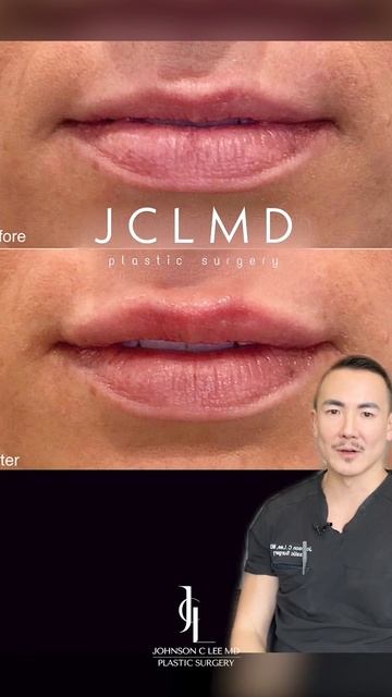 Plastic Surgeon Reacts to his Lip Filler Results | Dr. Johnson C. Lee | Beverly Hills, CA смотреть онлайн