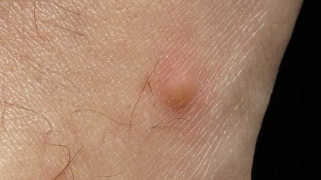 Why Do Mosquito Bites Itch?