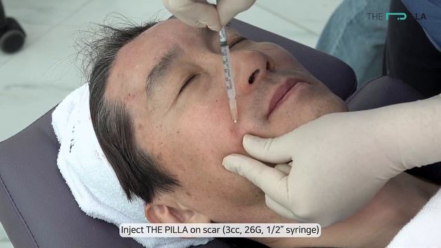 THE PILLA(PLLA Filler, Collagen Stimulator)