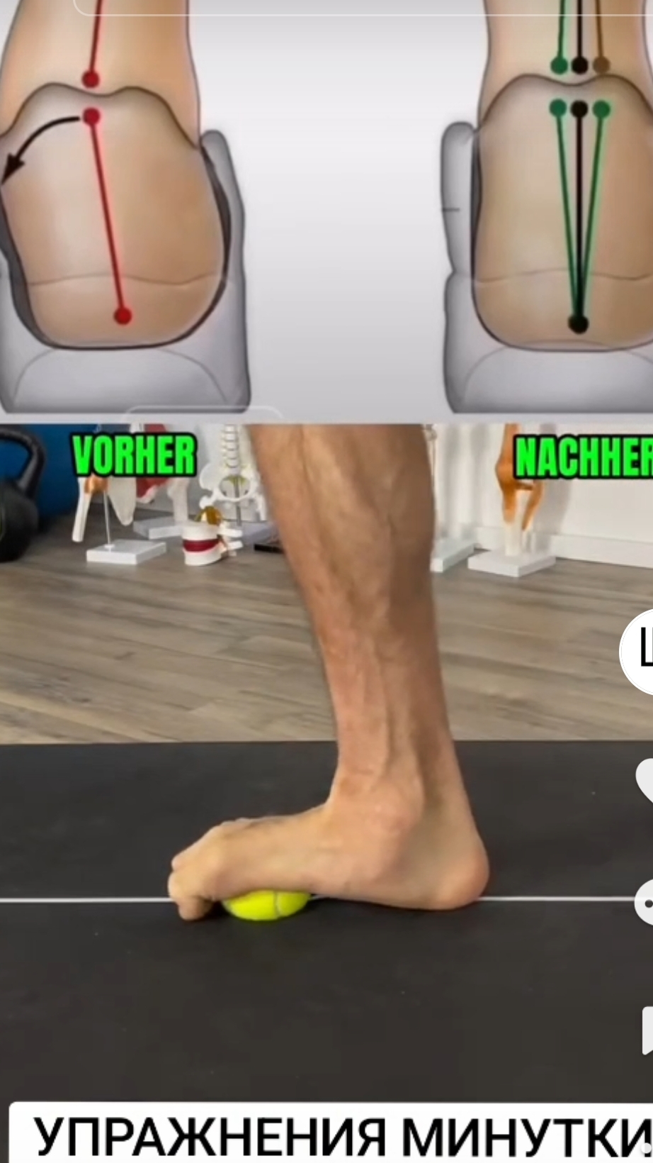 #плоскостопие #упражнениедляног #косточка #натоптыши #шпора #стельки #вальгус #пяточнаяшпора смотреть онлайн