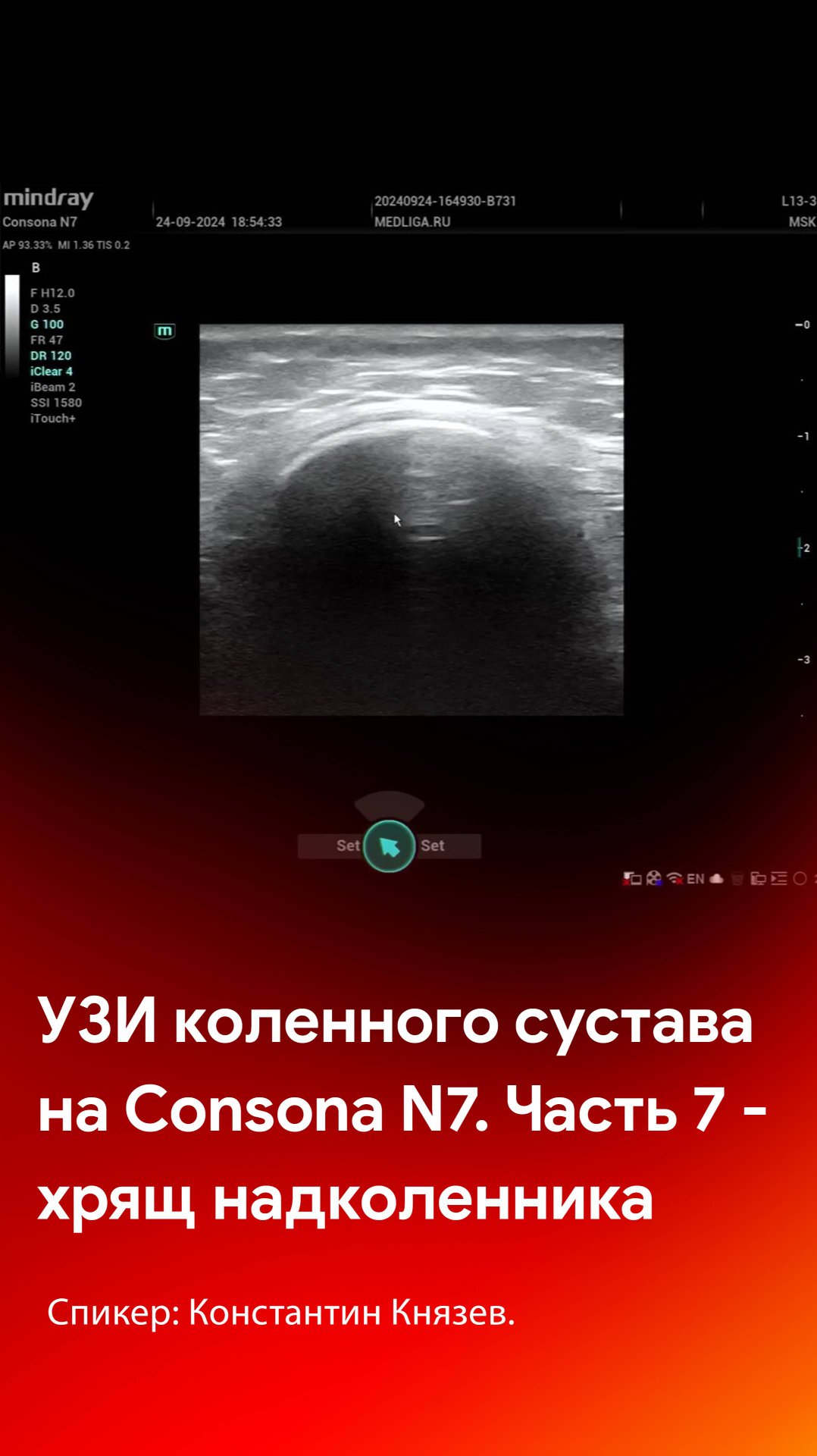 УЗИ коленного сустава на Mindray Consona N7. Часть 7 - сканирование хряща надколенника смотреть онлайн