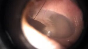 барабанная перепонка норма