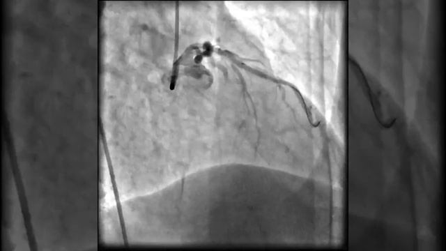 Infark Miokard Video