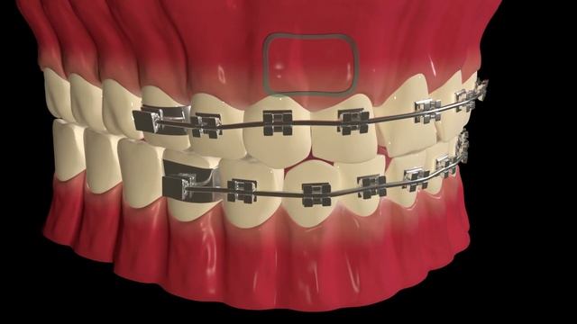 Как ставят брекеты смотреть онлайн