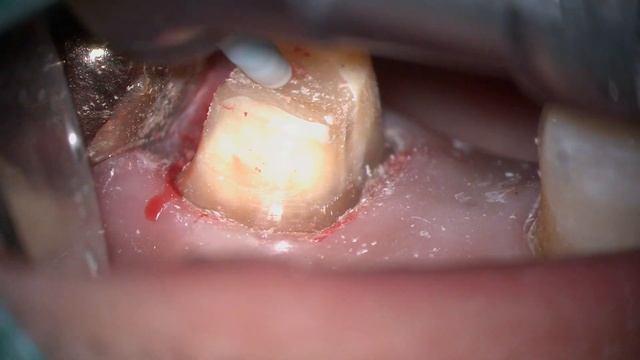 Crown Preparation Polishing,  Using KerrHawe Opticlean