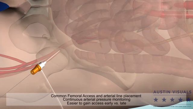 3D Balloon Catheter Explainer Animation | Austin Visuals смотреть онлайн