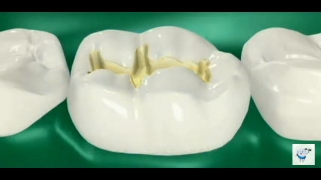 Composite Dental Filling Procedure смотреть онлайн